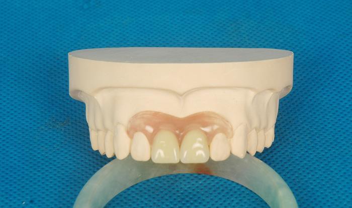 Inofensiva dentadura parcial de Valplast